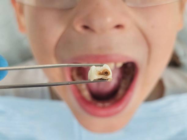 Best Emergency Wisdom Teeth Removal in Shougal, WA